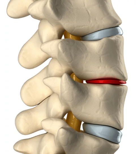 Osteocondrose da columna vertebral torácica