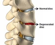Panel normal da columna vertebral, disco danado