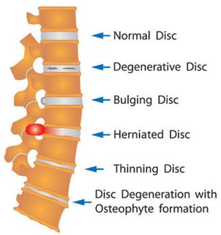 Varios danos no disco da columna vertebral