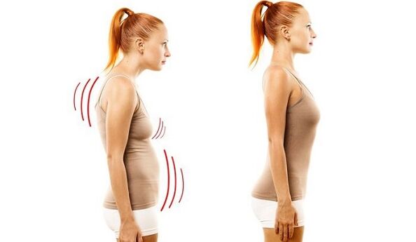 costas rectas e mala postura con osteocondrose cervical