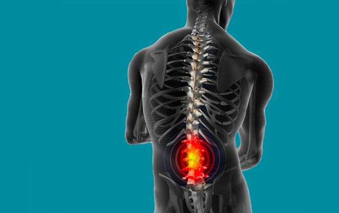 Dor nas costas na rexión lumbar