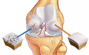 cartilaxe saudable e artrose da articulación do xeonllo